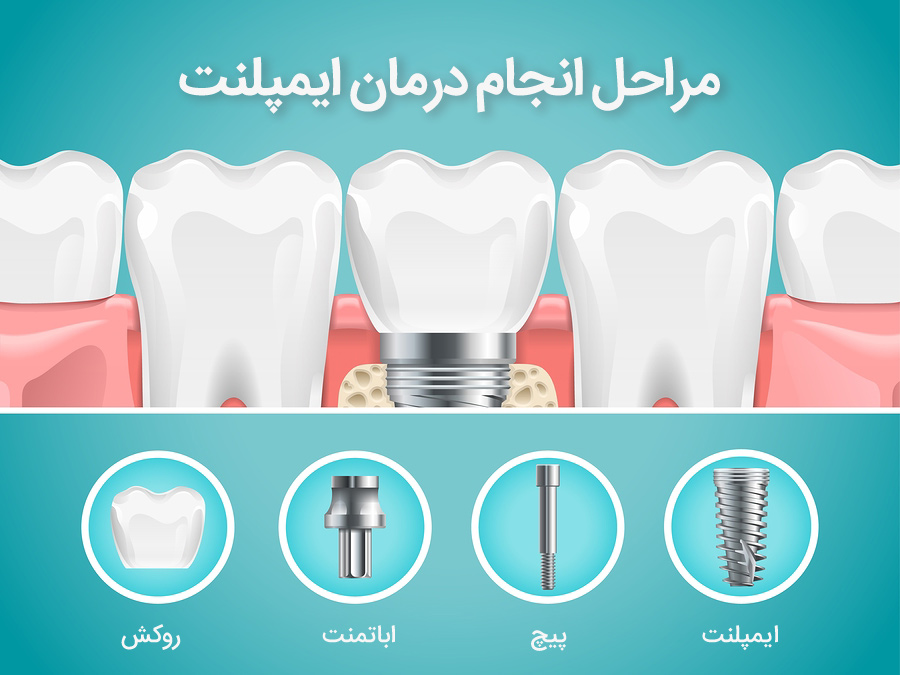 استاندارد جهانی مراحل انجام درمان ایمپلنت: پیشنهاد کلینیک تخصصی دانا